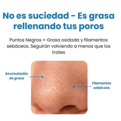 Krezia™ Quita Puntos Negros con Tecnología de Succión Avanzada.